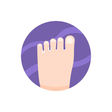 illustration of a foot affected by ringworm between the fingers. fungal skin disease. skin health conditions. flat cartoon style. vector design