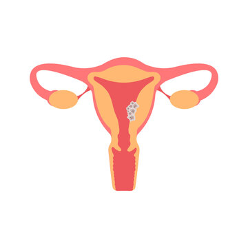 Uterus cancer flat illustration. Fertility, human anatomy, female reproductive system. Disease, gynecology, oncology.
Tumor cells on endometrium tissue of uterus