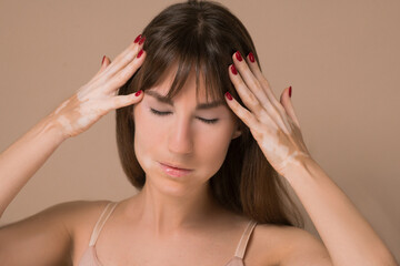 A young pretty long-haired woman with skin pigmentation suffering from a headache