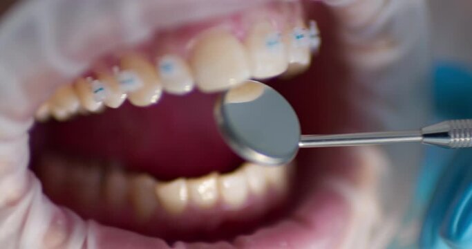 Close-up open mouth with optragate and ceramic braces on teeth and dental mirror is inspection a teeth.