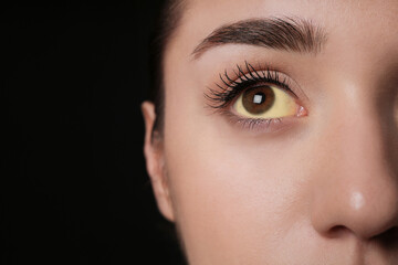 Woman with yellow eyes on black background, closeup and space for text. Liver problems symptom