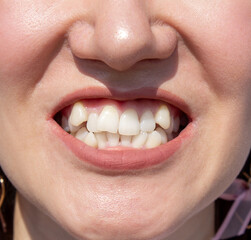 Curved female teeth, before installing braces. Close - up of teeth before treatment by an...