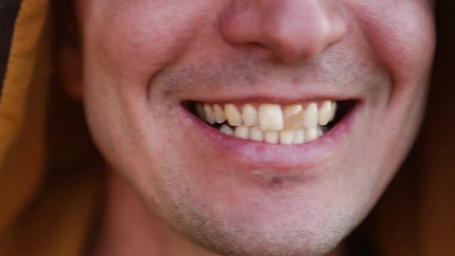 Yellow damaged tooth of smiling Caucasian man in the hood close-up. Focus on the teeth, open mouth. Dental problems, dead teeth, enamel whitening, aesthetic restoration. Natural enamel, body positive