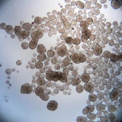 Human cancer cells under microscope