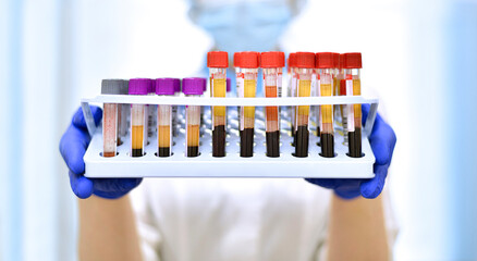 A laboratory medical worker demonstrates a stand with test tubes filled with venous blood for analysis.