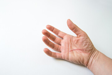 Human hand with a scar on white background