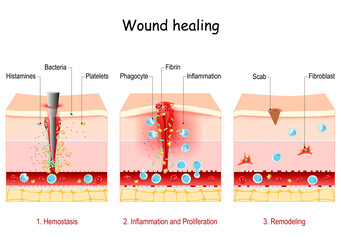 wound healing. Stages of the post-trauma repairing process