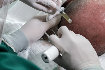 Balding man getting hair mesotherapy or scalp prp: Platelet-rich plasma procedure. Beautician...