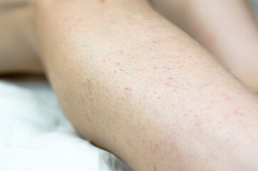 Hair on female legs. Ingrown hair problem. Hairy female legs close up.