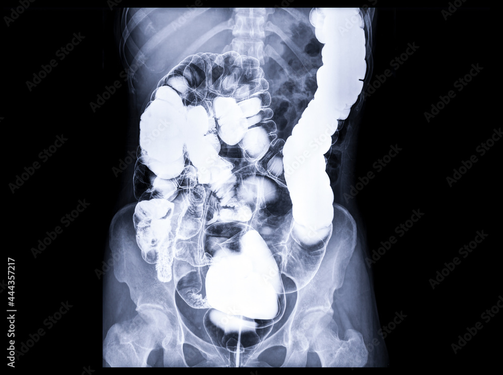 Poster barium enema or be is image of large bowel after injection of barium contrast fill into colon under 