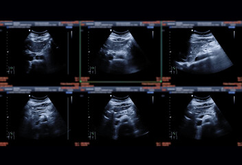 Ultrasound upper abdomen showing  Liver ,kidney, pancrease and gall bladder for detect HCC or Gall...