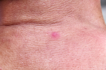 Naklejka premium Red rash skin background on back of asian old man neck