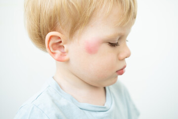 portrait of little Boy with allergic red spot at face cause by mosquito bite