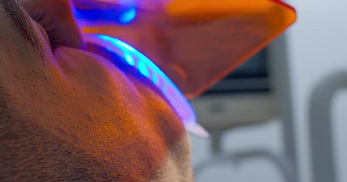 A close-up male patient with optragate on a mouth is having treatment by using curing light for solidification filling on a tooth.