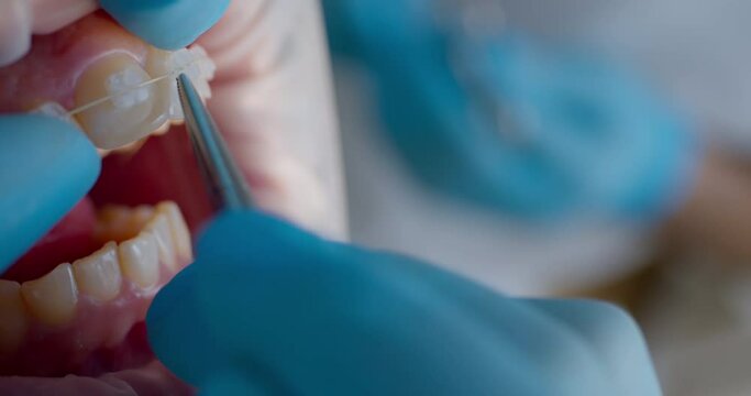 Close-up an open mouth with optragate and ceramic braces on the teeth and orthodontist is using dental forceps to putting white ligature ties on braces. The patient is having orthodontic treatment.
