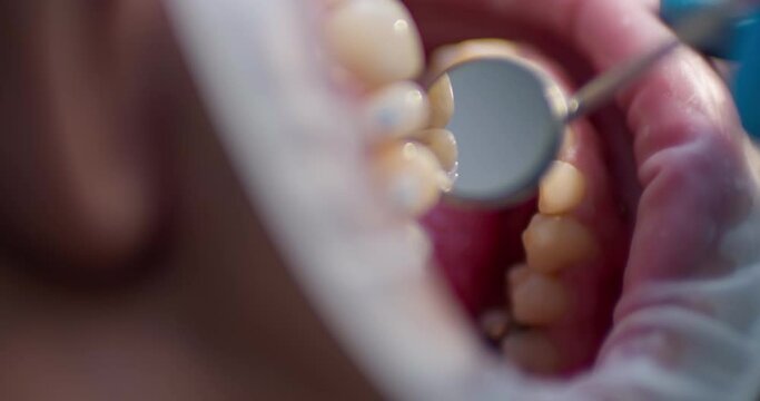 Close-up open mouth with optragate and on teeth are ceramic braces. Teeth inspection by using a dental mirror.
