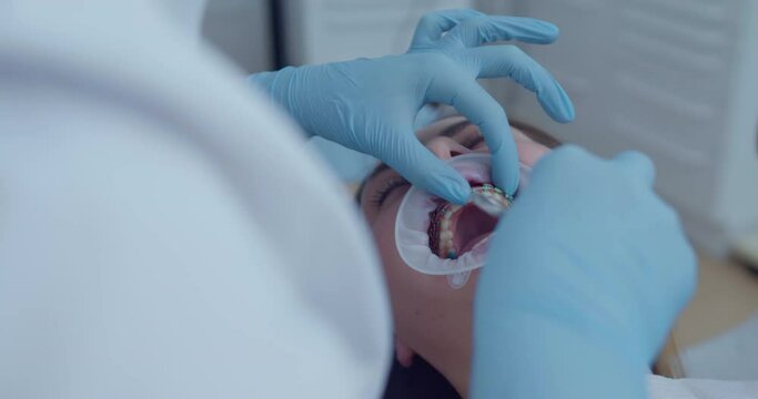 Close-up female patient face with optragate and bracket system on teeth, orthodontist hand is putting by using dental scissors a green elastic on the metal braces with the multiloop archwire.