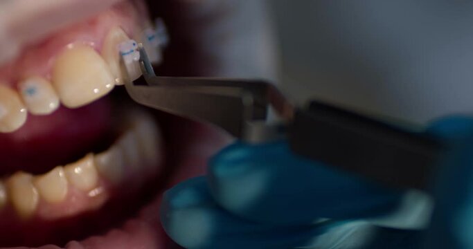 Close-up of an open mouth with optragate and on the tooth of the upper jaw is applying a ceramic brace.
