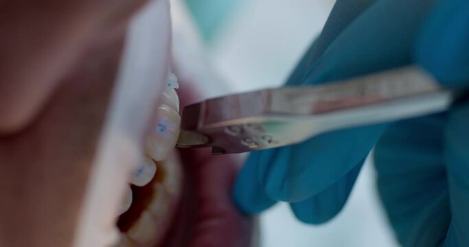 Close-up male open mouth with optragate and on teeth are ceramic braces. On the tooth is applying an orthodontic bracket positioner.
