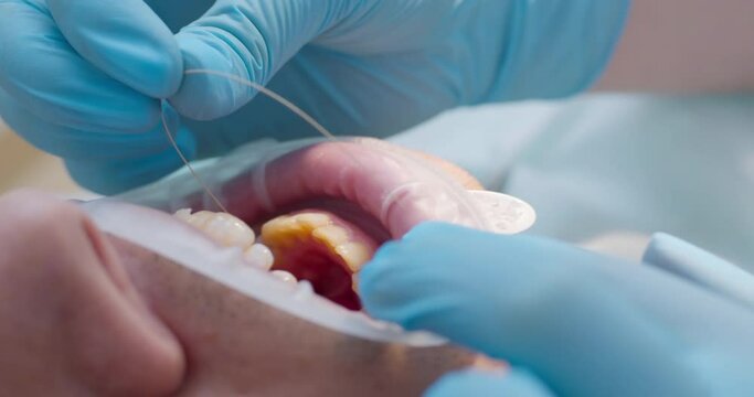 close-up a male patient with an open mouth and optragate on the lips is applying archwire into ceramic ligature braces.