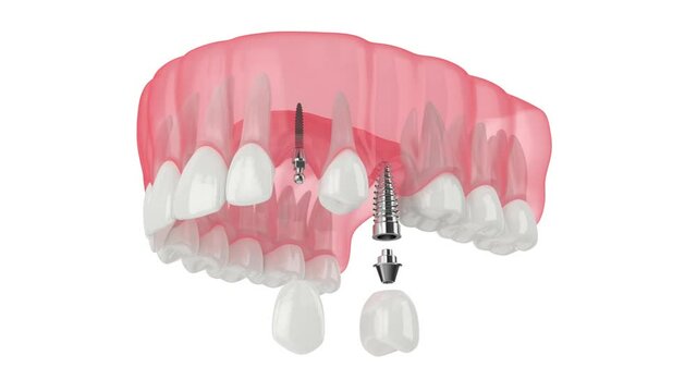 Upper jaw with two types of dental implants placement over white background