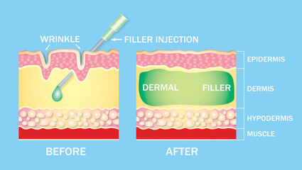 injectable cosmetic filler or Dermal fillers