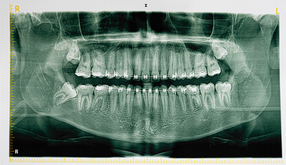 Dental x-ray photo of teenager skull and teeth with braces. Orthodontic treatment for healthy teeth. Tooth straightening health care
