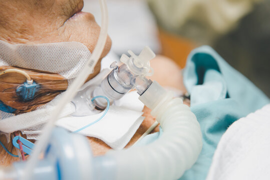 Patient do tracheostomy and ventilator in hospital
