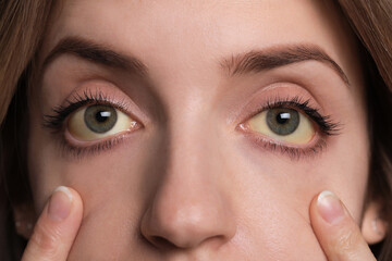 Obraz premium Woman checking her health condition, closeup. Yellow eyes as symptom of problems with liver