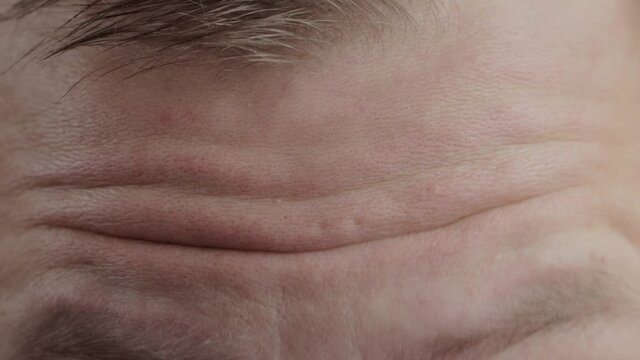 Wrinkles on a man's forehead, close-up. Facial expression. Wrinkle treatment