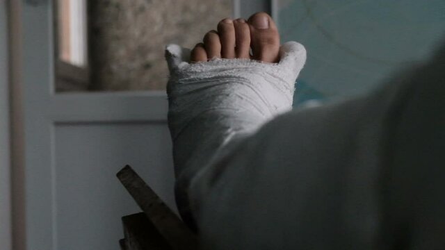 Young man with broken plaster leg