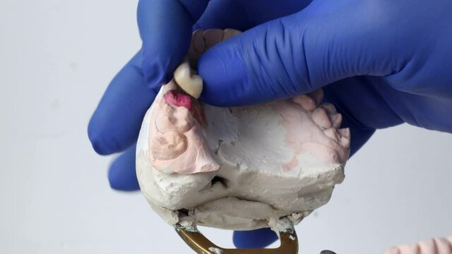 The dentist examines the metal-ceramic bridge prosthesis on a plaster model.