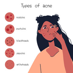 Acne types chart. Vector illustration of skin problems. Acne on the skin of a girl on a white background. Vector flat illustration 