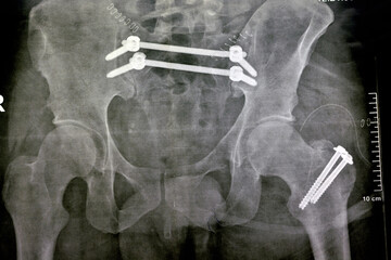 Plain x ray with a fracture pelvis that is fixed with 4 screws and 2 rods and fracture of greater trochanter of femur fixed with 2 screws and fracture of symphysis pubis, ileo-iliac pelvic fixation - obrazy, fototapety, plakaty