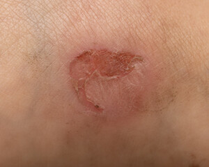 Fototapeta premium leg injury from uncomfortable shoes