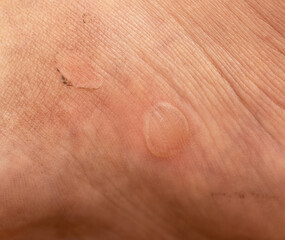 Fototapeta premium callus from shoes as a background