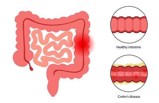 Chrons disease concept