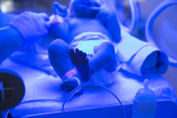 Karmienie noworodka w inkubatorze. Żółtaczka niemowlaków. Fototerapia