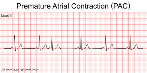 Electrocardiogram show Premature Atrial Contraction (PAC) pattern ,Heart beat ,ECG ,EKG interpretation ,Vital sign ,Life line ,Medical healthcare symbol. - obrazy, fototapety, plakaty