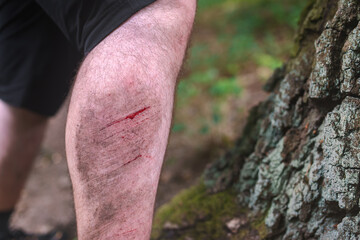 Abraded leg of a man after a fall on a forest trail.