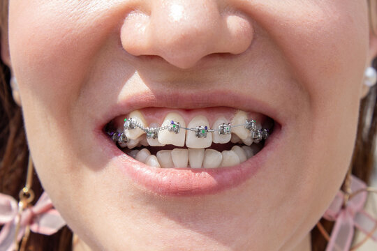 Curved female teeth, after installing braces. Close-up of the teeth after treatment at the orthodontist.Brasket system in a girl's smiling mouth, macro photography of teeth. Braces on the girl's teeth