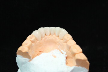 Fototapeta na wymiar Dental crowns and veneers in the plaster model