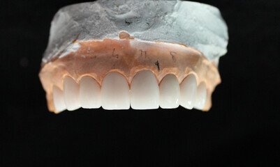 Fototapeta na wymiar Dental veneers for new smile