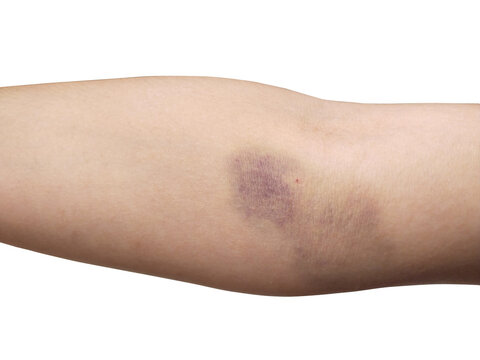 Bruises from injections. Bruise. Scar from vaccination on arm. skin re-bleeding