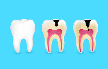 Healthy tooth and tooth caries. Superficial caries; deep caries; enamel and dentin decay; periodontitis.