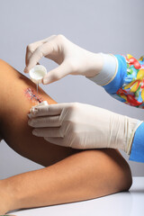 Doctor's hands pouring hydrogen peroxide on sutured wound to clean it