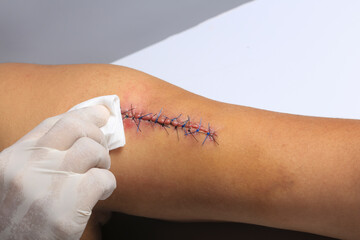 Suture on arm being cleaned by a female doctor