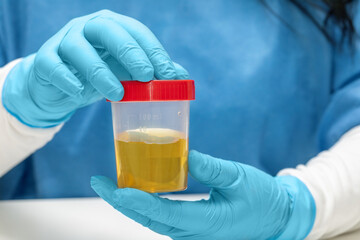  doctor or laboratory technician holds a plastic container with a urine sample for analysis