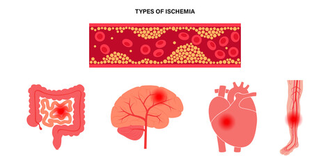 Types of ishemia