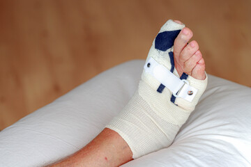 Health care concept, Foot surgery, Wrapped feet with plaster or pressure bandage after operation,...